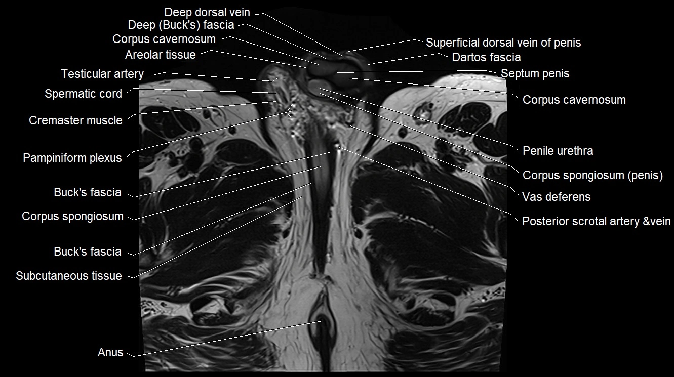 MRI 3T scrotum and penis axial cross sectional anatomy image 23.webp